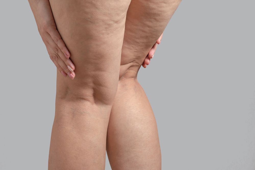 Almost everyone has cellulite, and that's okay