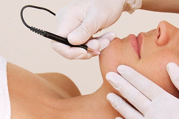 Different Facial Hair Removal Methods: Waxing, Laser and Electrolysis